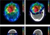 What Is Proton Therapy?