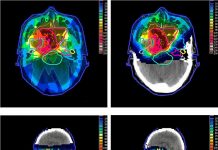 What Is Proton Therapy?