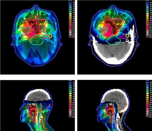 What Is Proton Therapy?