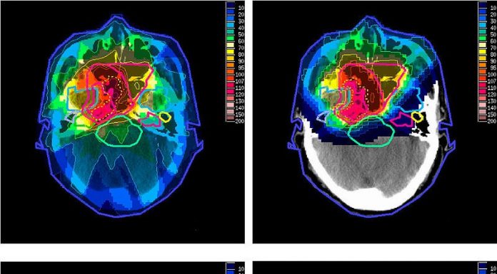 What Is Proton Therapy?